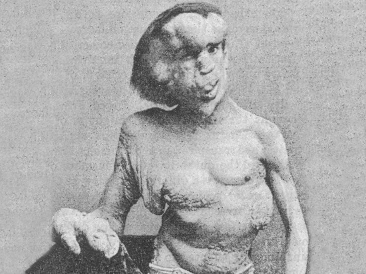 Joseph Merrick posing