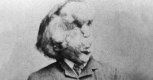Portrait of Joseph Merrick