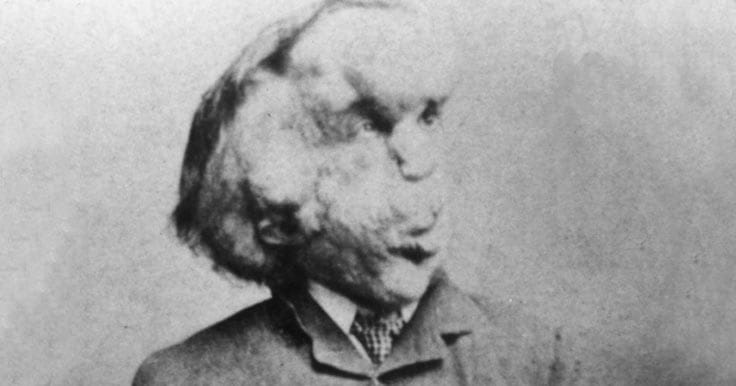 Portrait of Joseph Merrick