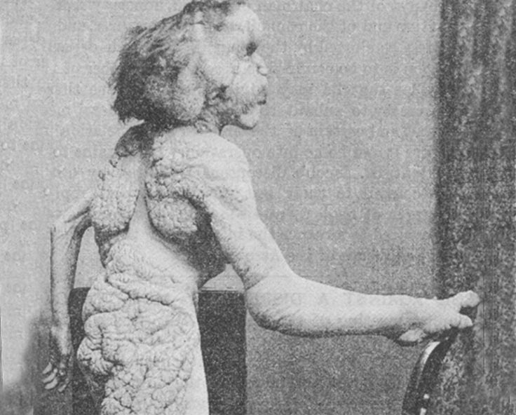Joseph Merrick posing with a chair