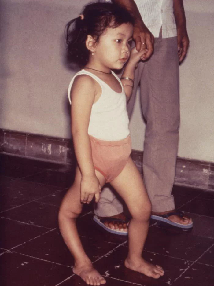 Child who has the physical affects of polio